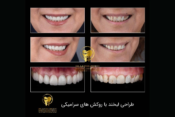 مراحل انجام لمینت سرامیکی دندان